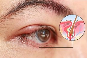 ocular rosacea