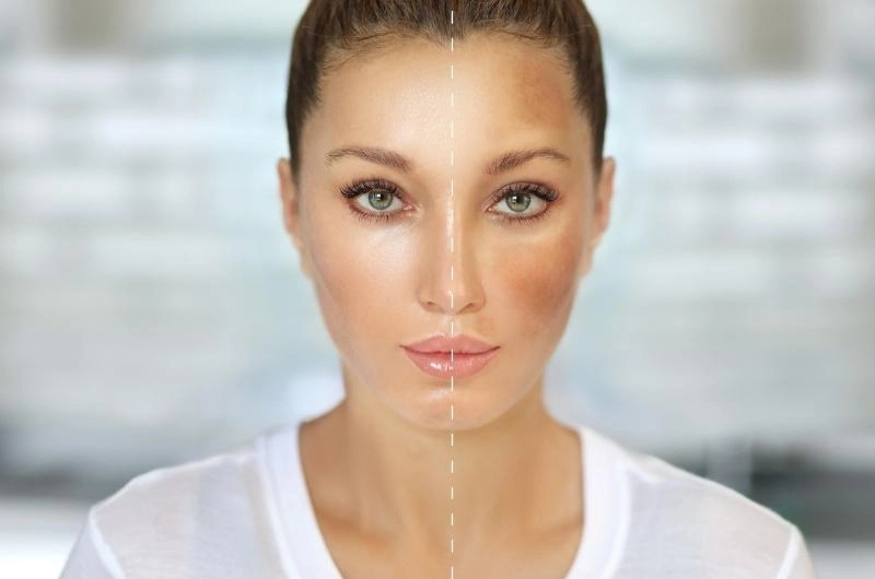 hyperpigmentation and demodex mites