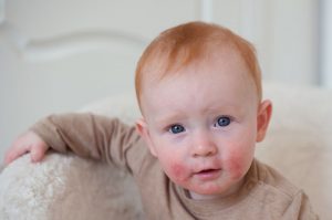 Atopic dermatitis-Ungex