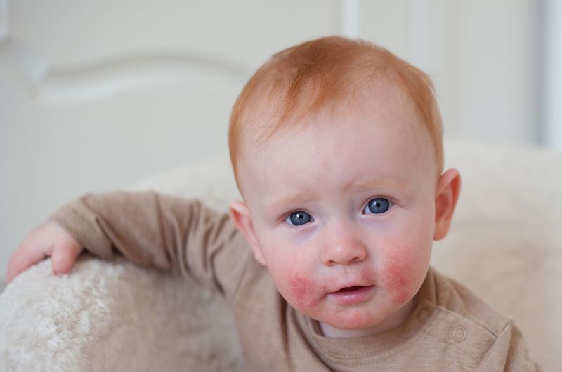 Atopic dermatitis-Ungex