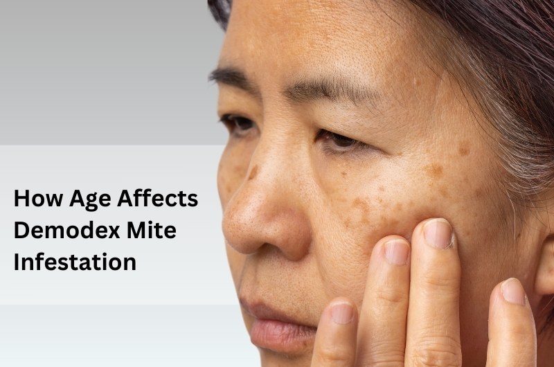 how age affects demodex mite infestation