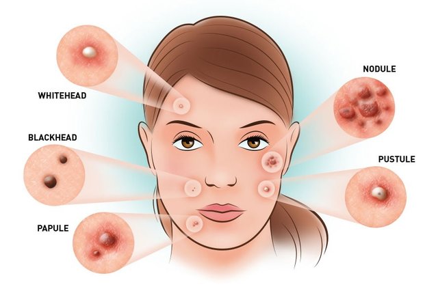 acne1 | آنجکس | دمودکس | مایت