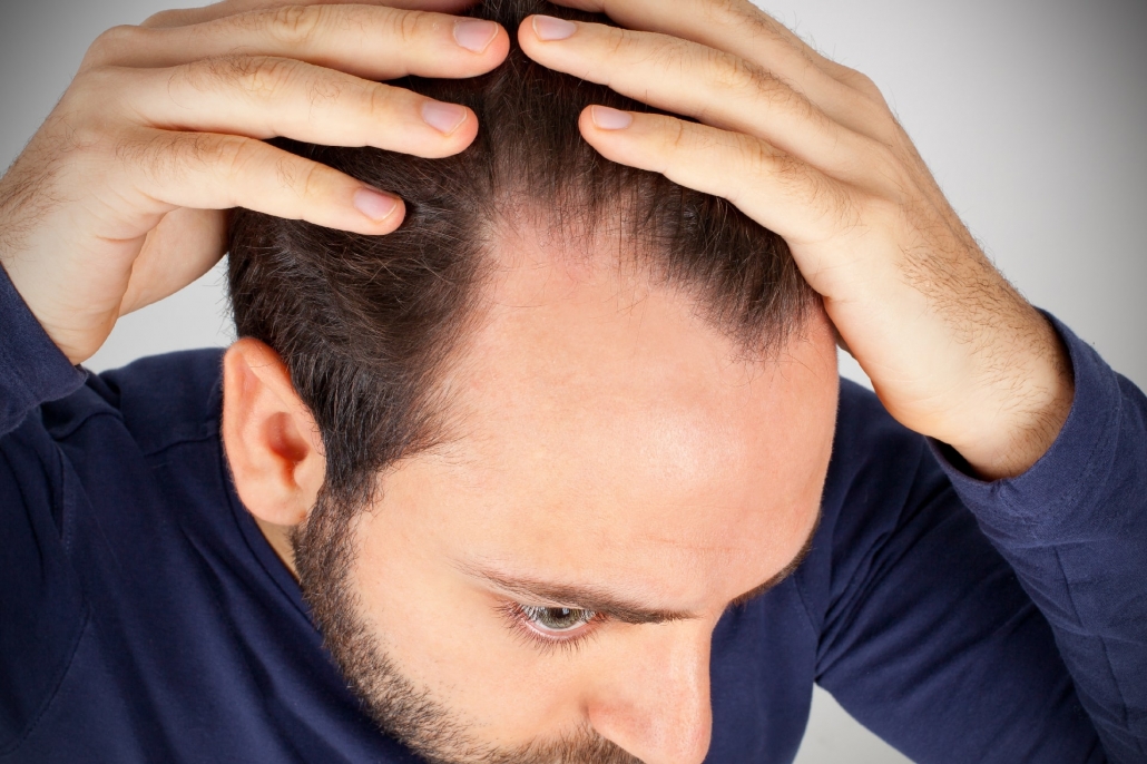 ارتباط ریزش مو با انگل دمودکس | آنجکس
