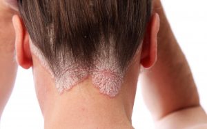 درماتیت سبوره ای | آنجکس