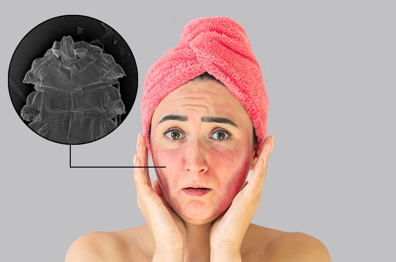 rosacea and demodex