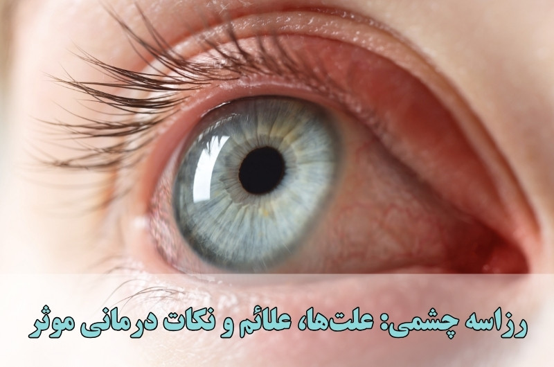 رزاسه چشمی علت‌ها، علائم و نکات درمانی موثر
