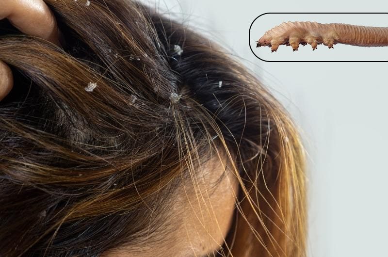 demodexanddandruff-ungexfa-blog demodex and dandruff