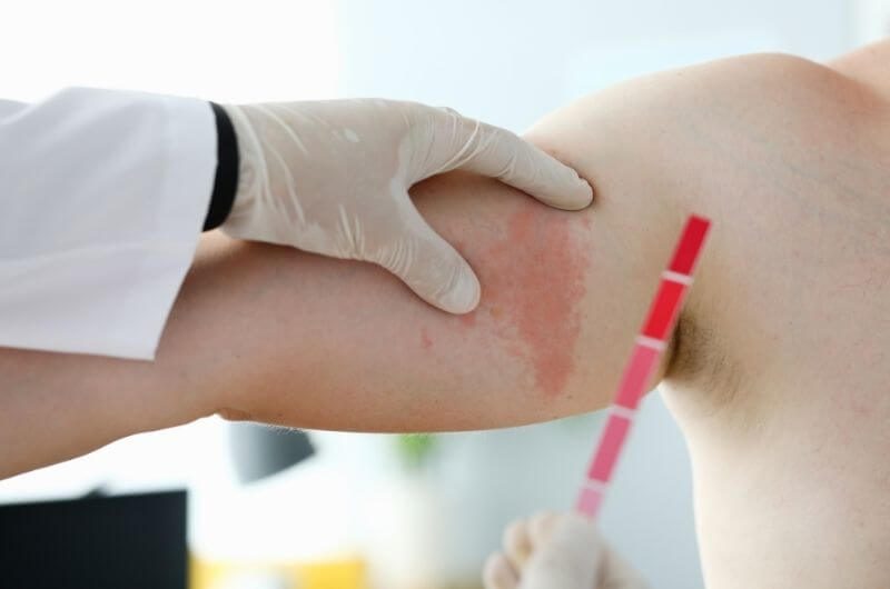red skin syndrome-ungexfa روزاسه