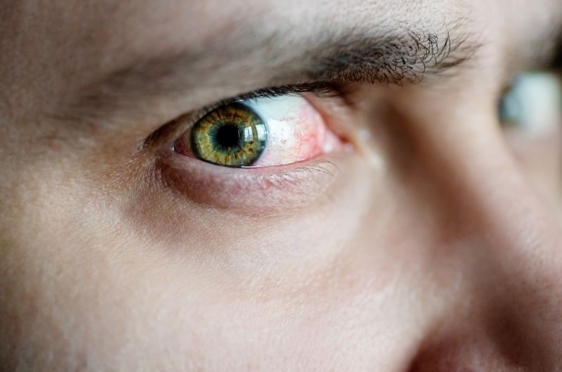 redness-of-eyes-ungexfa-blog قرمزی چشم و دمودکس