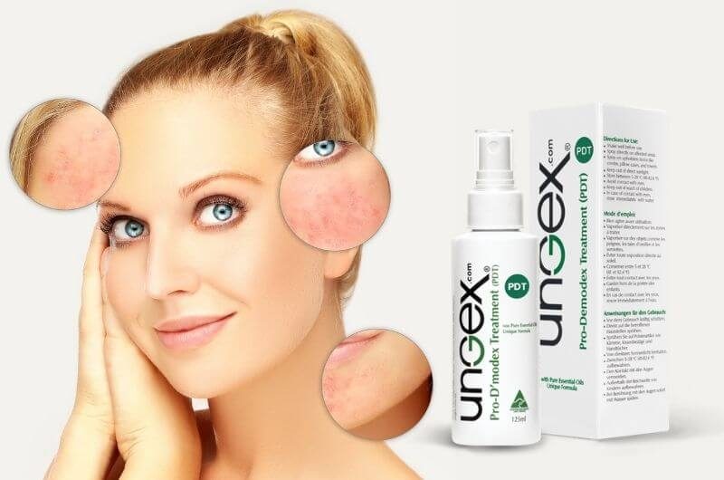 rosacea-ungexfa روزاسه