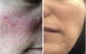 Demodex testimonials | Ungex