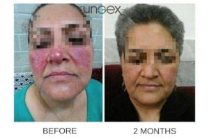 Demodex testimonials | Ungex