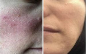 Rosacea Testimonials | Ungex
