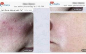 Rosacea Testimonials | Ungex