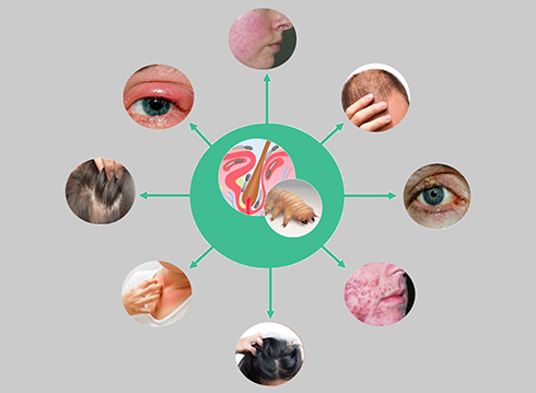 symptoms Demodex-symptoms | Ungex
