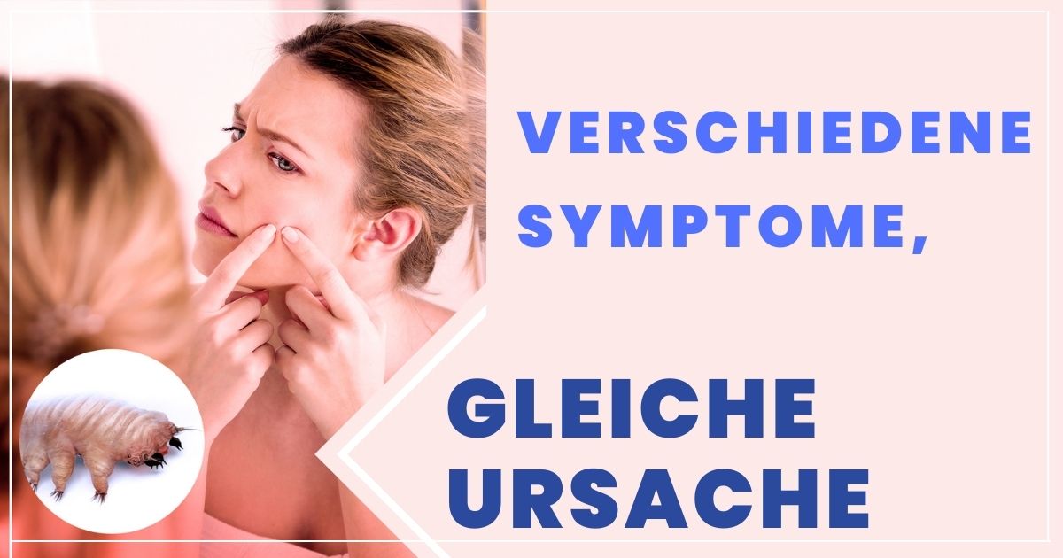 Demodex Milben und ihre Symptome Global Ungex