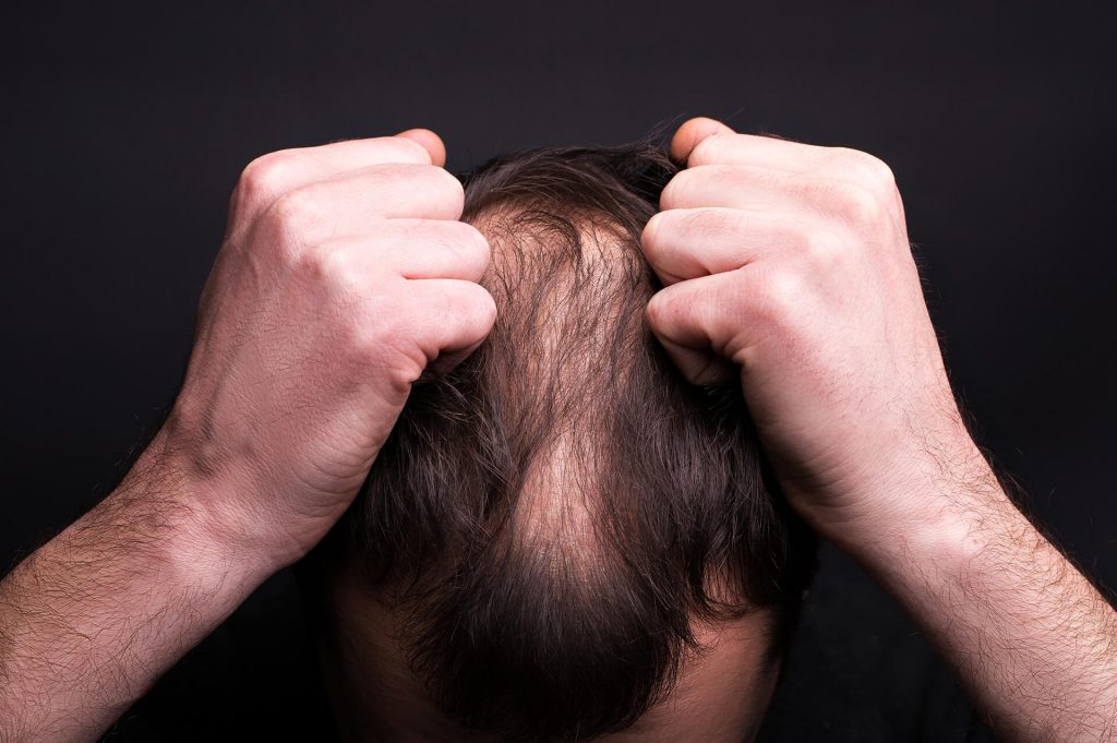 Alopecia | Ungex