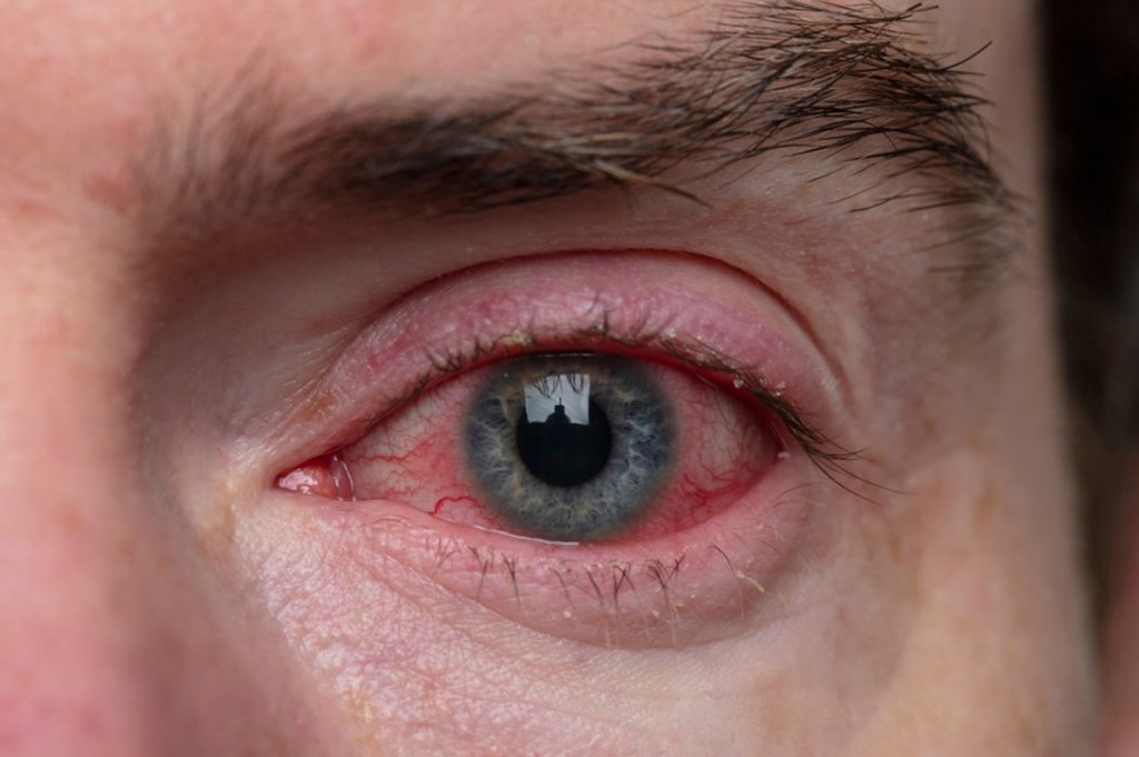 Blepharitis | Ungex