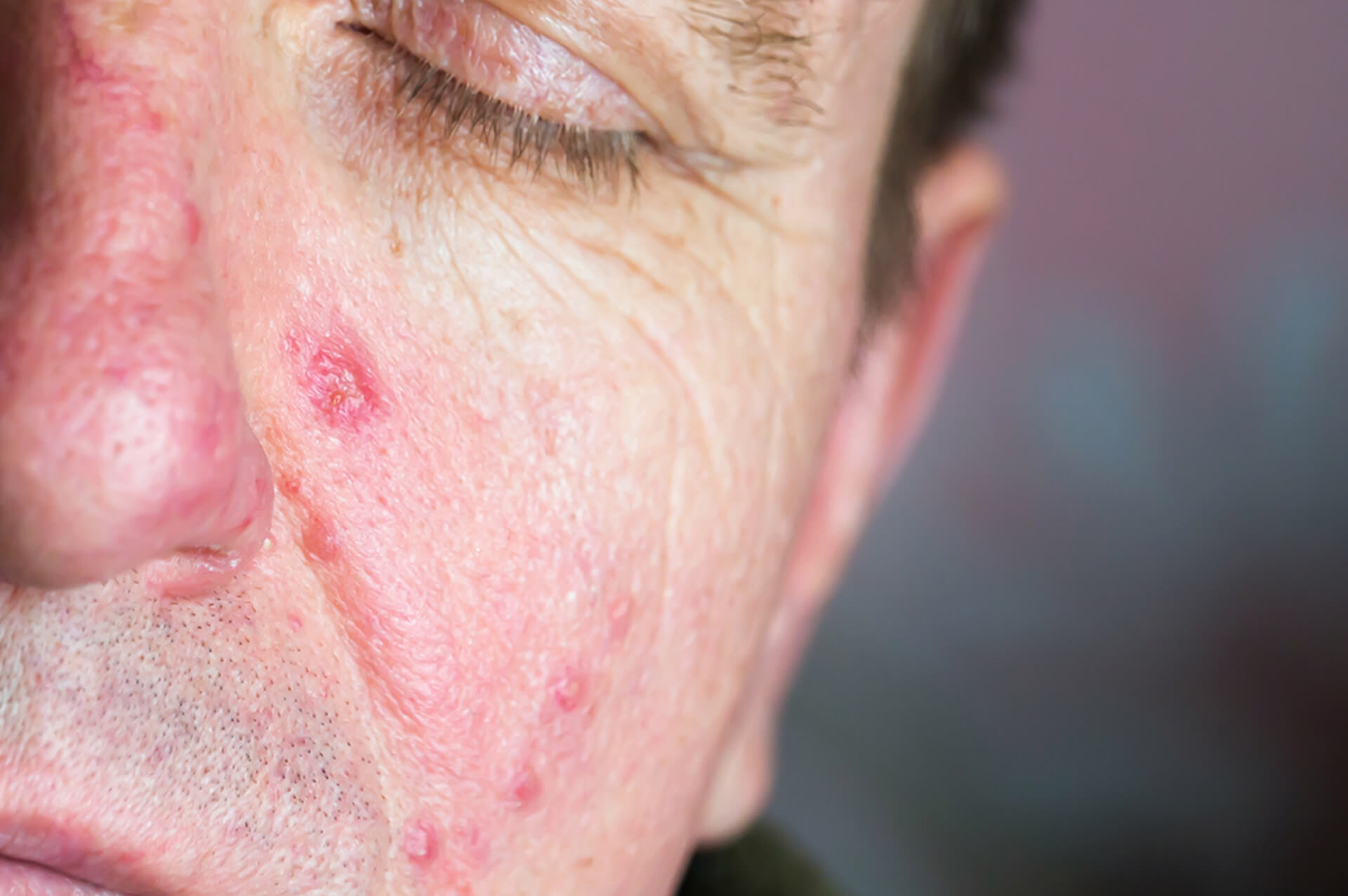 Mehr über Milben Ungex Demodex Behandlung für Haarmilben
