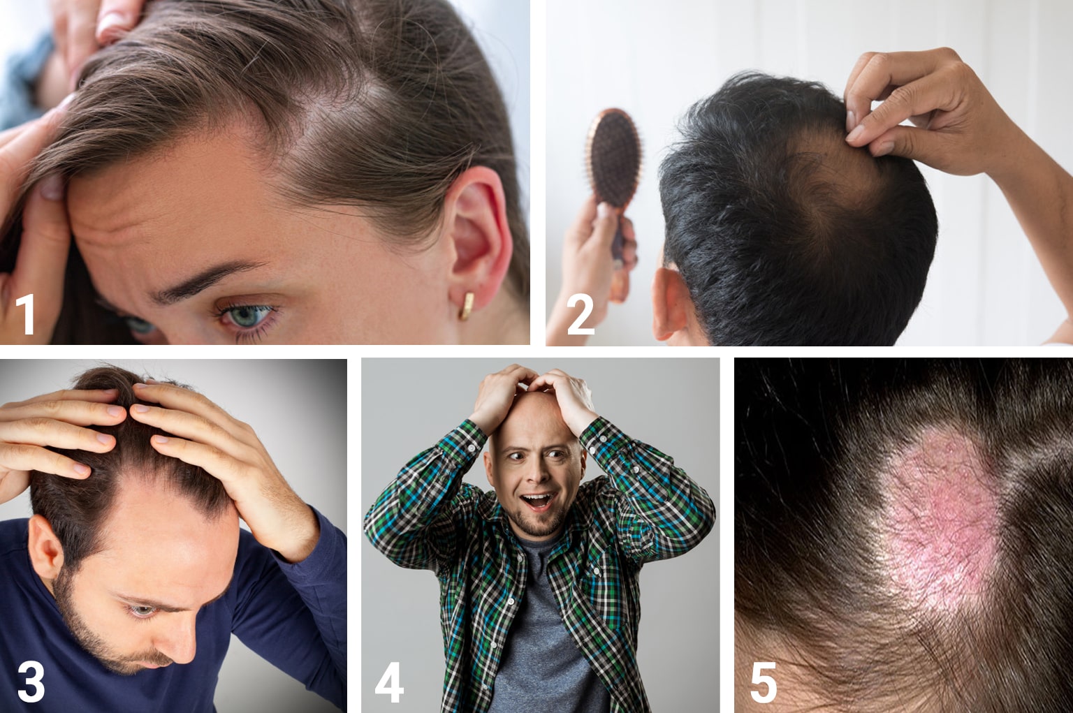 أعراض تساقط الشعر | انجکس