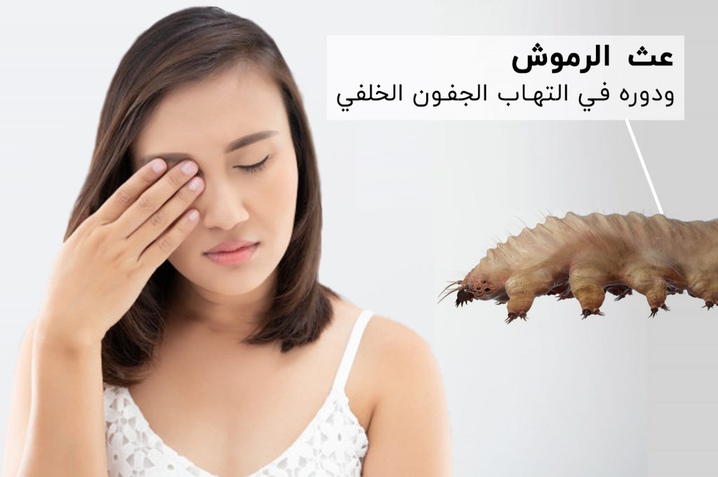 عث الرموش ودوره في التهاب الجفون الخلفي