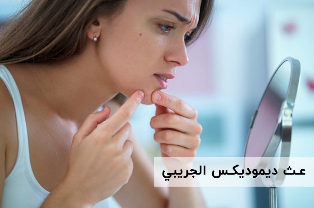 عث ديموديكس الجريبي | انجکس