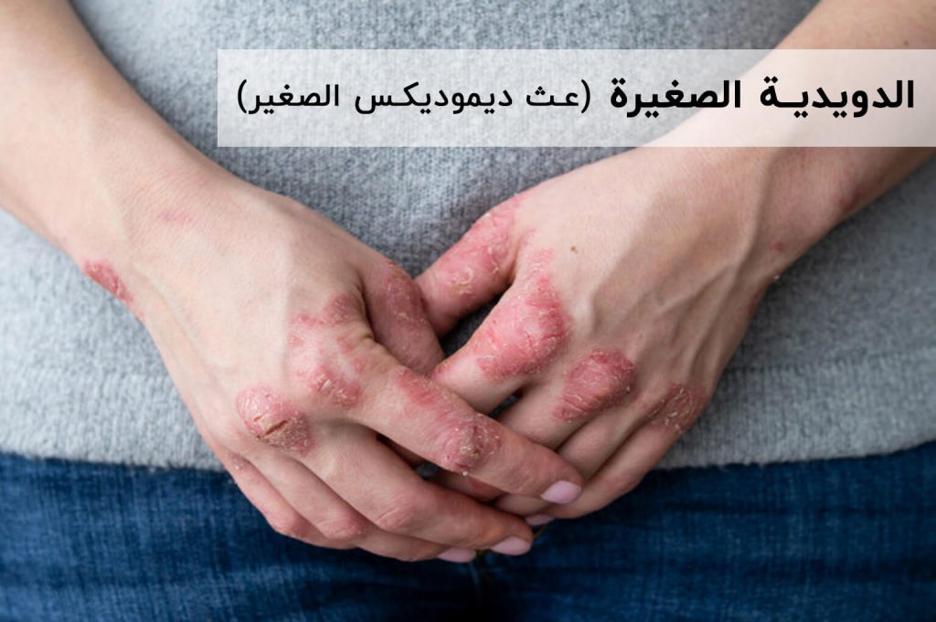 عث ديموديكس الصغير | انجکس