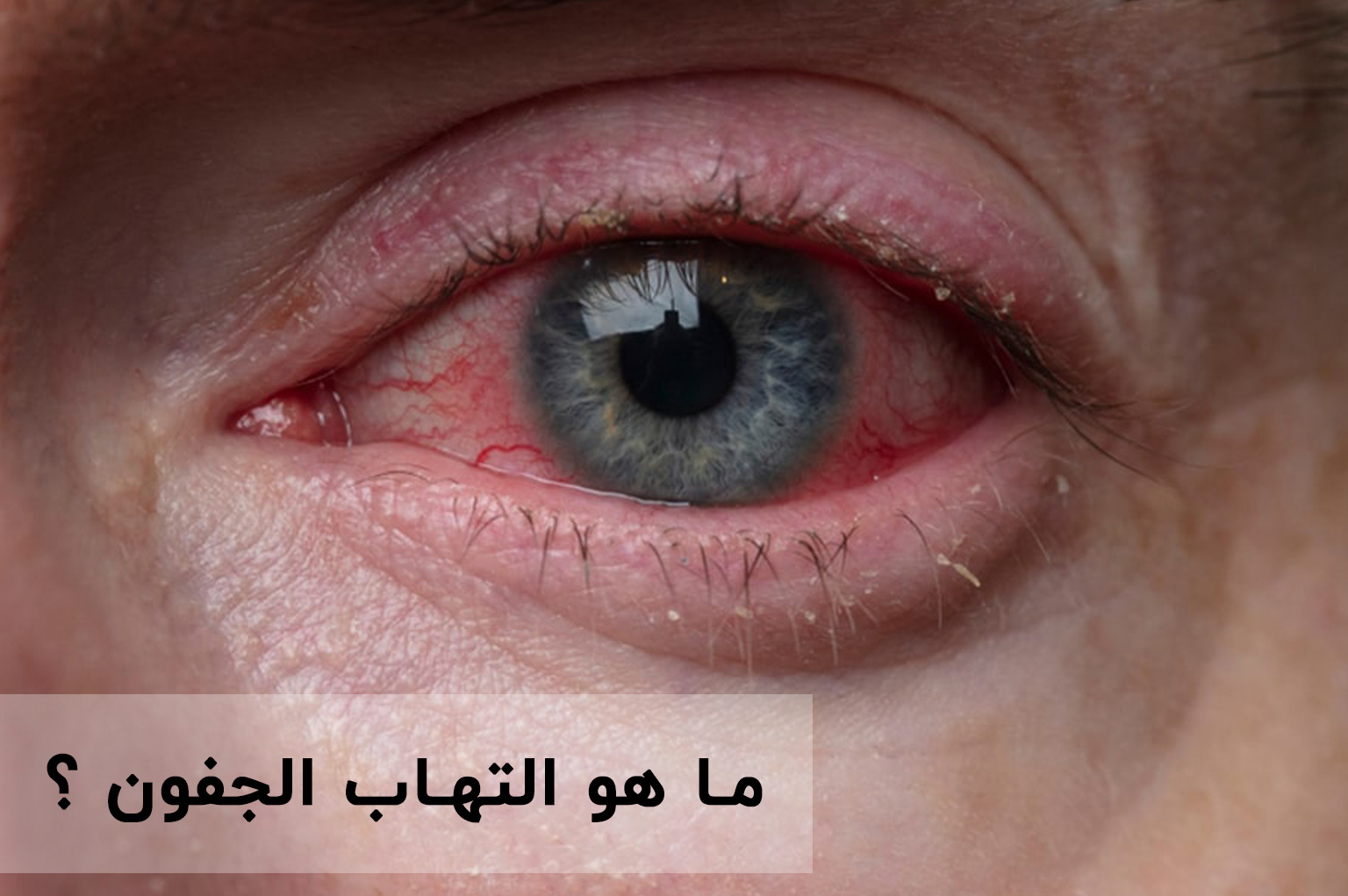 ما-هو-التهاب-الجفون-؟