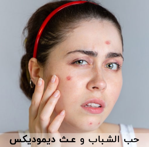 حب الشباب و عث ديموديكس | انجکس