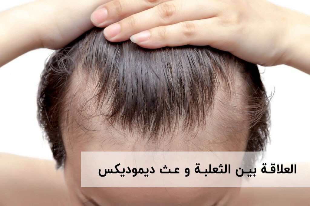 العلاقة بين الثعلبة و عث ديموديكس | انجکس