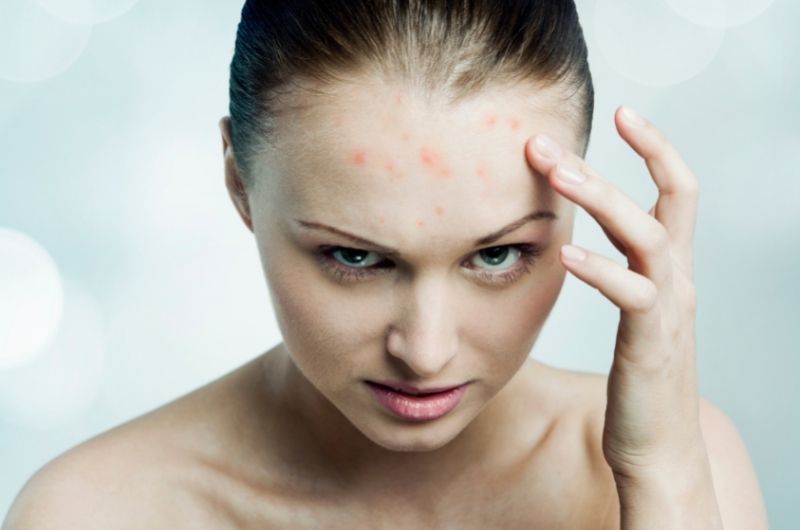 acne and demodex