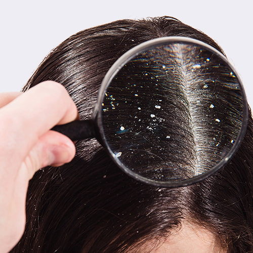 Dandruff-Demodex mites