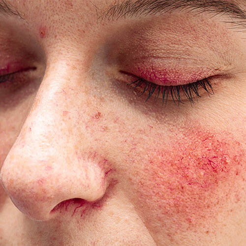 Rosacea-Demodex mites