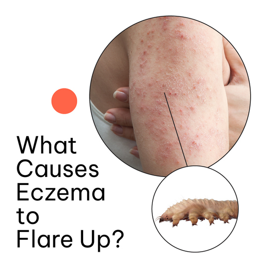 What causes eczema-ungex