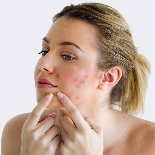 acne-Demodex mites