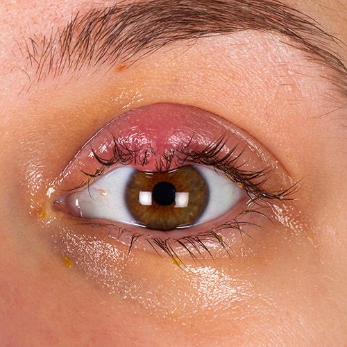 blepharitis