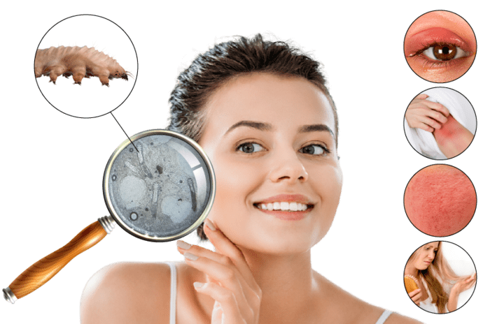 demodex symptoms
