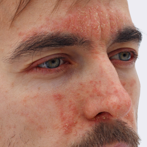 Dermatitis seborrheic