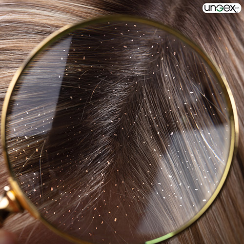 Can dandruff be a sign of mites-ungex
