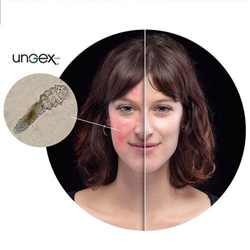 How to treat demodex rosacea