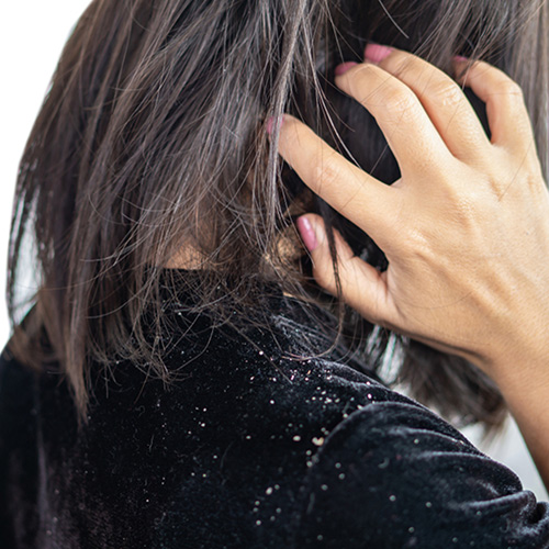 Is dandruff caused by demodex-ungex