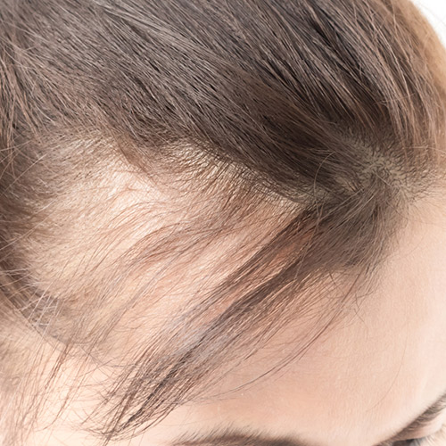 Treat demodex hair thinning