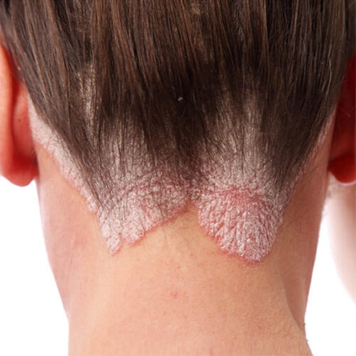 Seborrheic dermatitis-ungex
