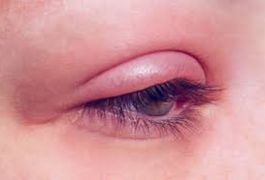 Anterior blepharitis