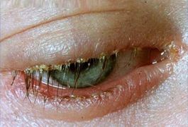Causes of Blepharitis