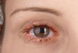 Posterior blepharitis