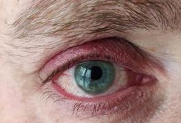 Types of Blepharitis
