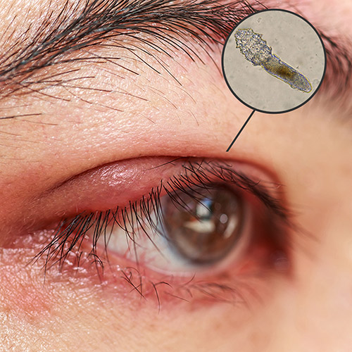 Types of blepharitis