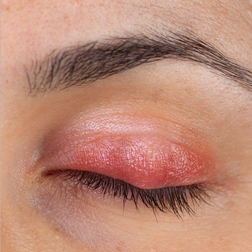 What is demodex blepharitis