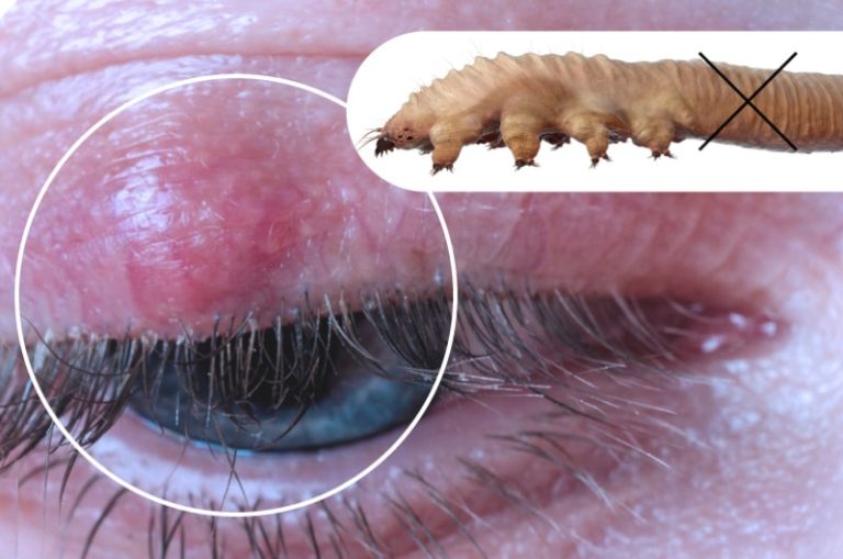 Eyelash Extensions, Demodex and Blepharitis Ungex